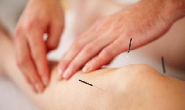 akupunktura, naturopatia kolano igły czuć